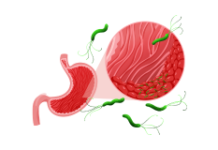 Helicobacter pylori: comprendre et agir naturellement Hélicobater pylori